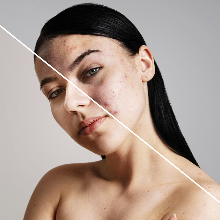 Diba Hair and Beauty Acne treatment Diba Hair And Beauty Acne Treatment